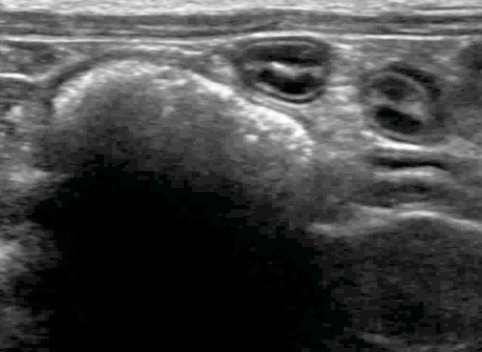 Formation EAN2 : Echographie abdominale normale : Partie 2 - surrénales, noeuds lymphatiques, tube digestif, pancréas, vascularisation.