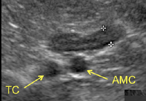 Formation EAN2 : Echographie abdominale normale : Partie 2 - surrénales, noeuds lymphatiques, tube digestif, pancréas, vascularisation.