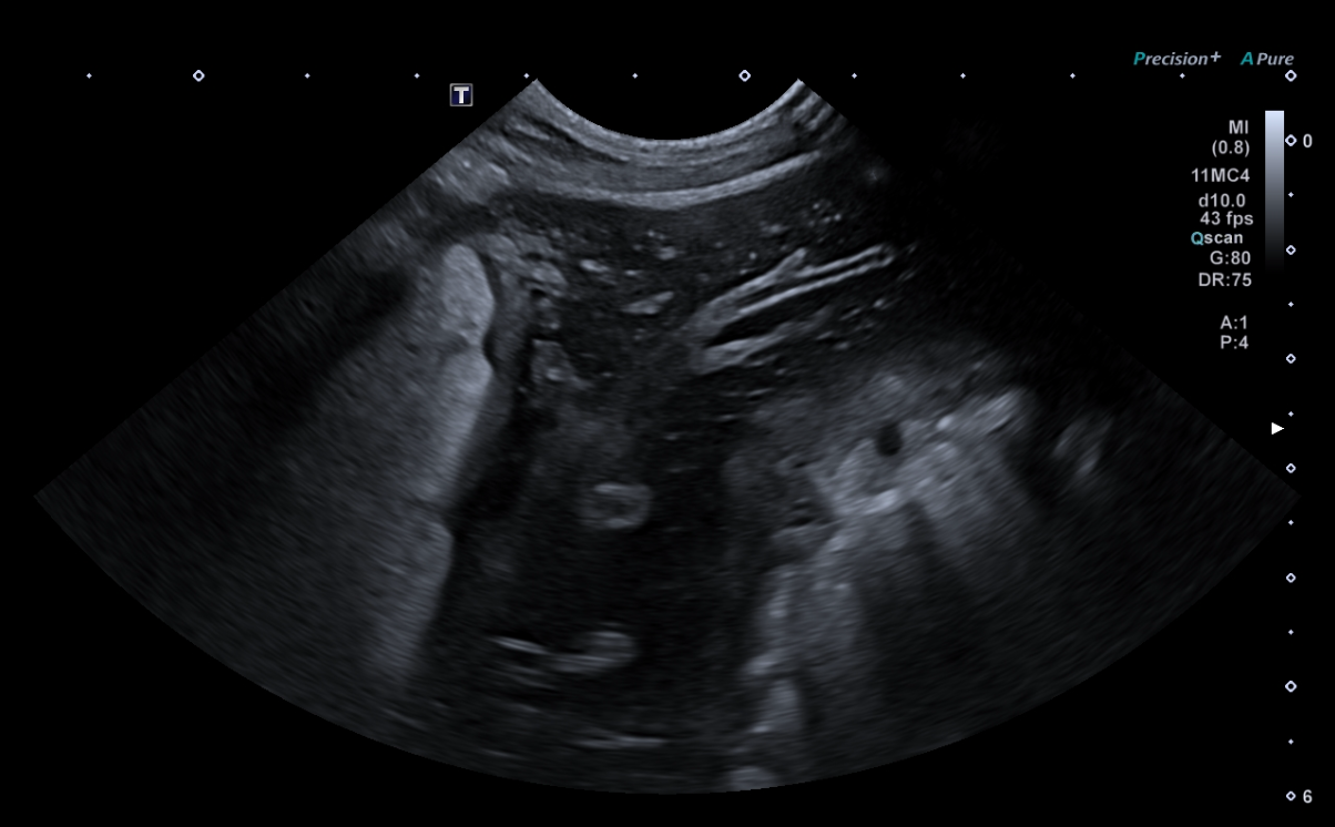 Formation EAP1-LIVE : Echographie abdominale pathologique: Foie - Rate