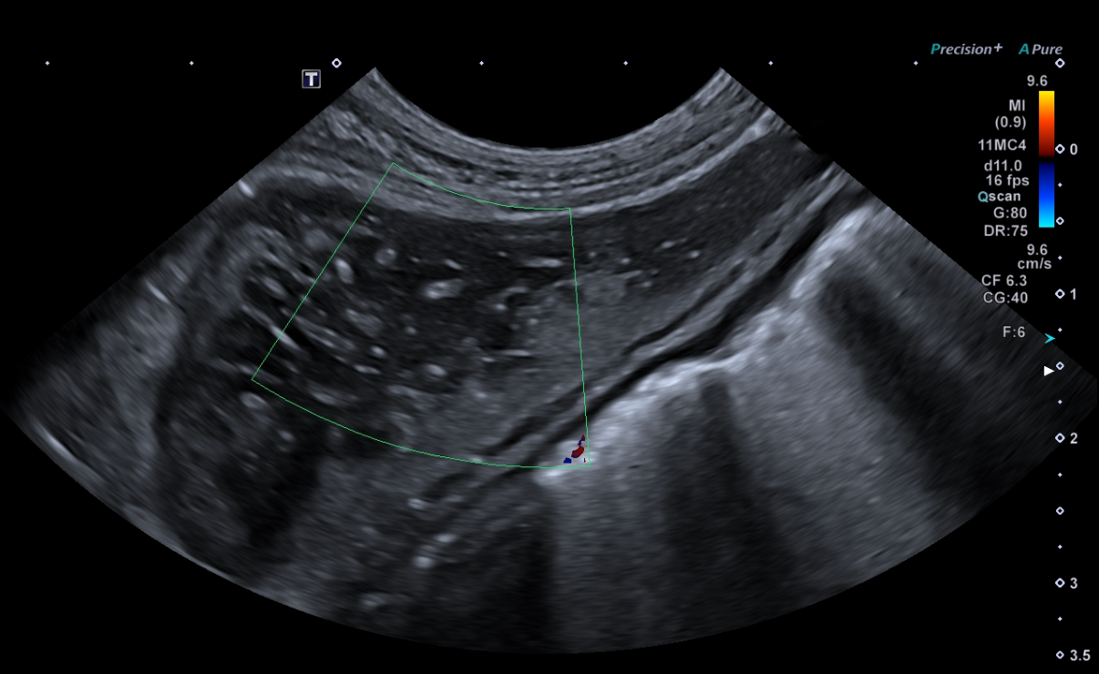 Formation EAP1-LIVE : Echographie abdominale pathologique: Foie - Rate