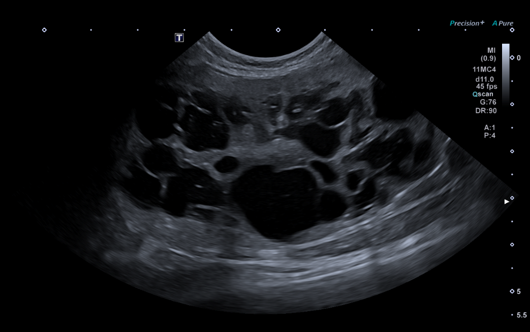 Formation EAP2-LIVE : Echographie abdominale pathologique: Appareil urinaire et génital