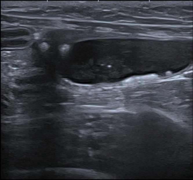 Formation EAP2-LIVE : Echographie abdominale pathologique: Appareil urinaire et génital