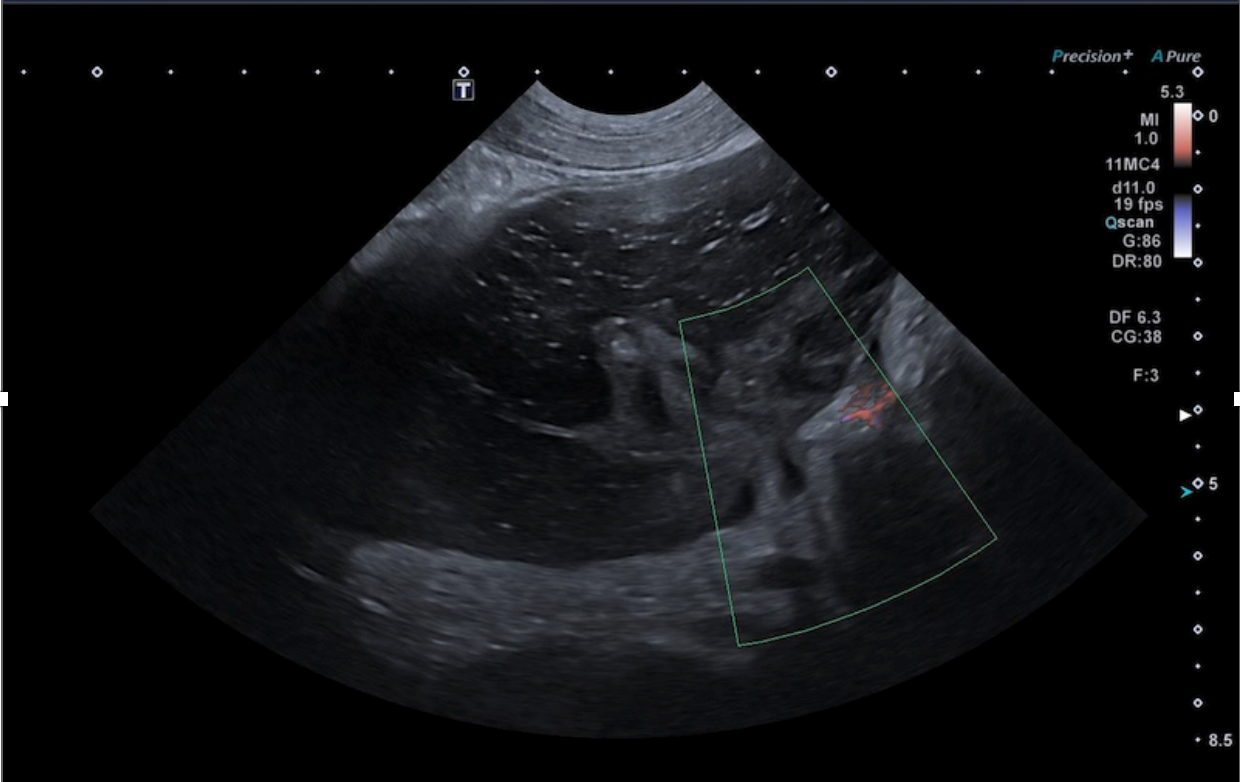 Formation EAP3-LIVE : Echographie abdominale pathologique: Tube digestif, pancréas et surrénales