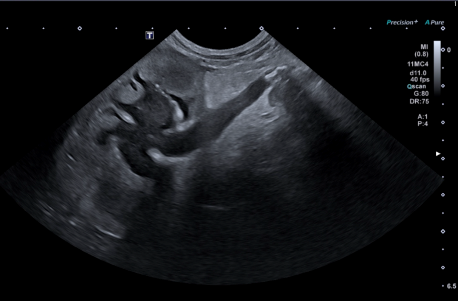 Formation EAP3-LIVE : Echographie abdominale pathologique: Tube digestif, pancréas et surrénales