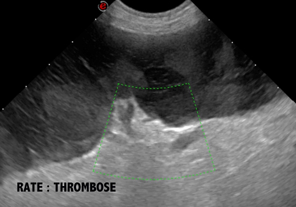 Formation ECHOFAST : Echographie en urgence (protocole F.A.S.T.)