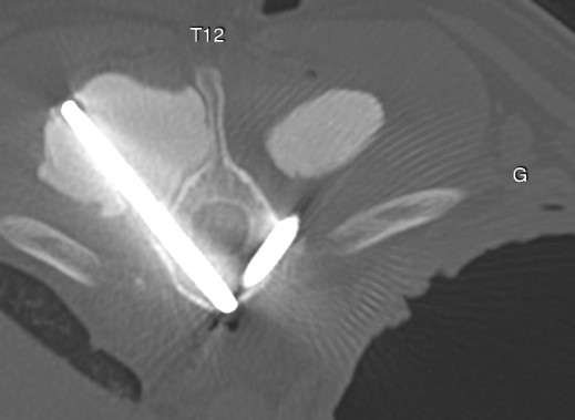 Formation NCHIR2-B : Neurochirurgie avancée : corpectomie cervicale et introduction à la stabilisation