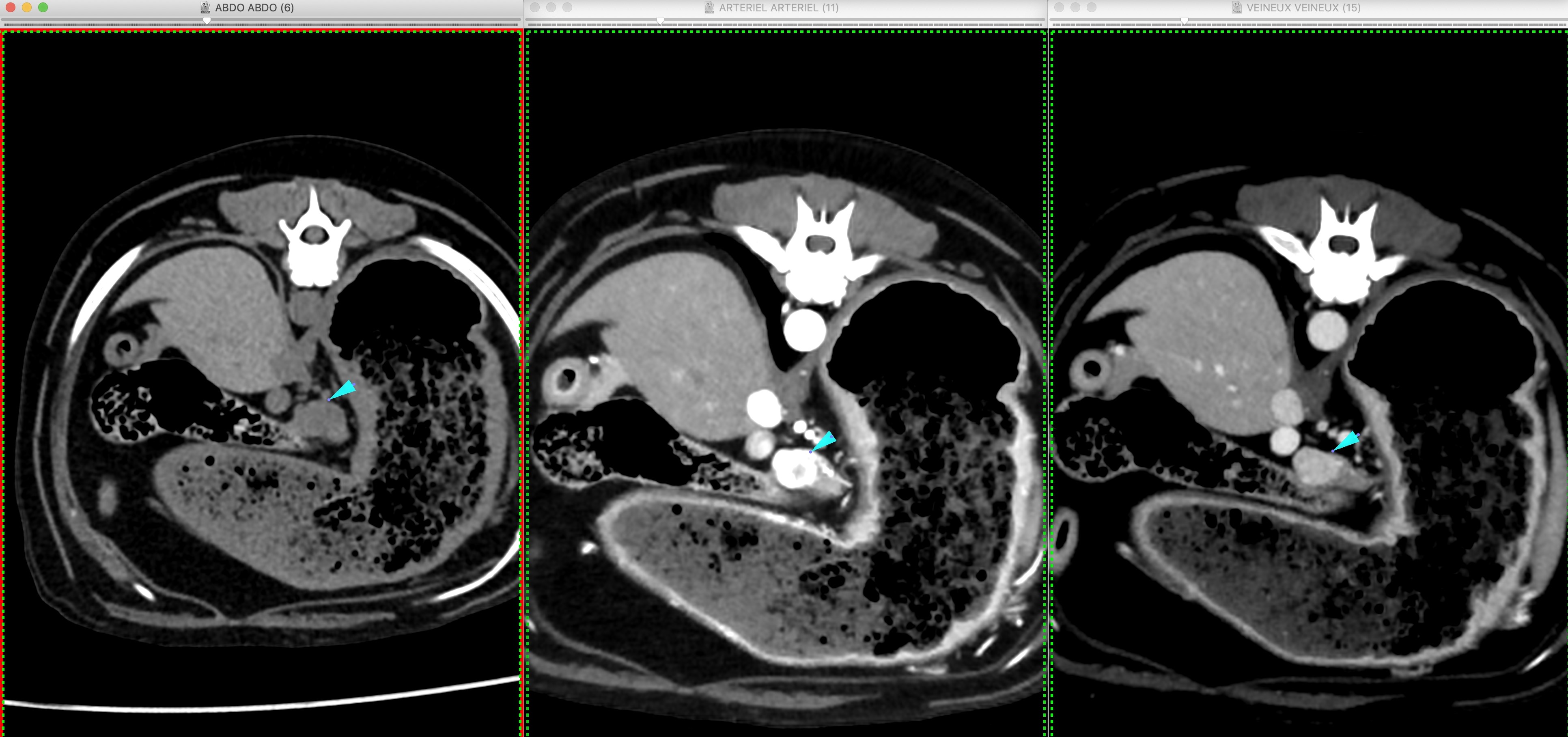 Formation SCANB : Module Scanner: Niveau 2: Vasculaire thoracique et abdominal, tube digestif, surrénales, affections naso-sinusales, cérebrales...