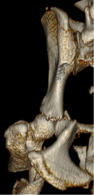 Formation CHIR6B : Chirurgie du bassin : quand et comment traiter les fractures pelviennes ?